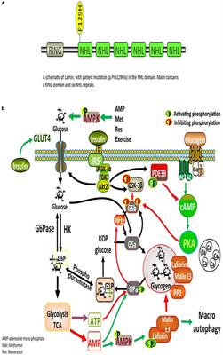 Diabetes Mellitus in a Patient With Lafora Disease: Possible Links With Pancreatic β-Cell Dysfunction and Insulin Resistance